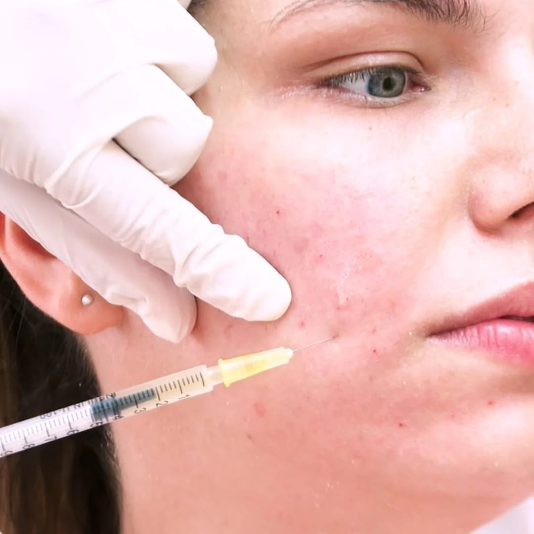 Mesotherapy Custom Facial Treatment