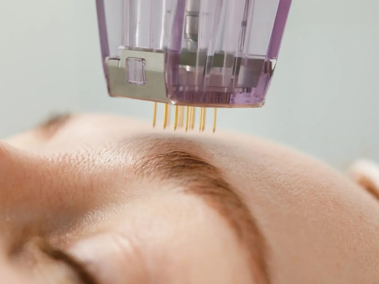 Microneedling Treatment